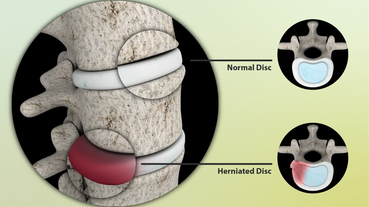 Normal disk ile fıtıklaşmış (herniye) disk karşılaştırmasını gösteren 3 boyutlu omurga illüstrasyonu