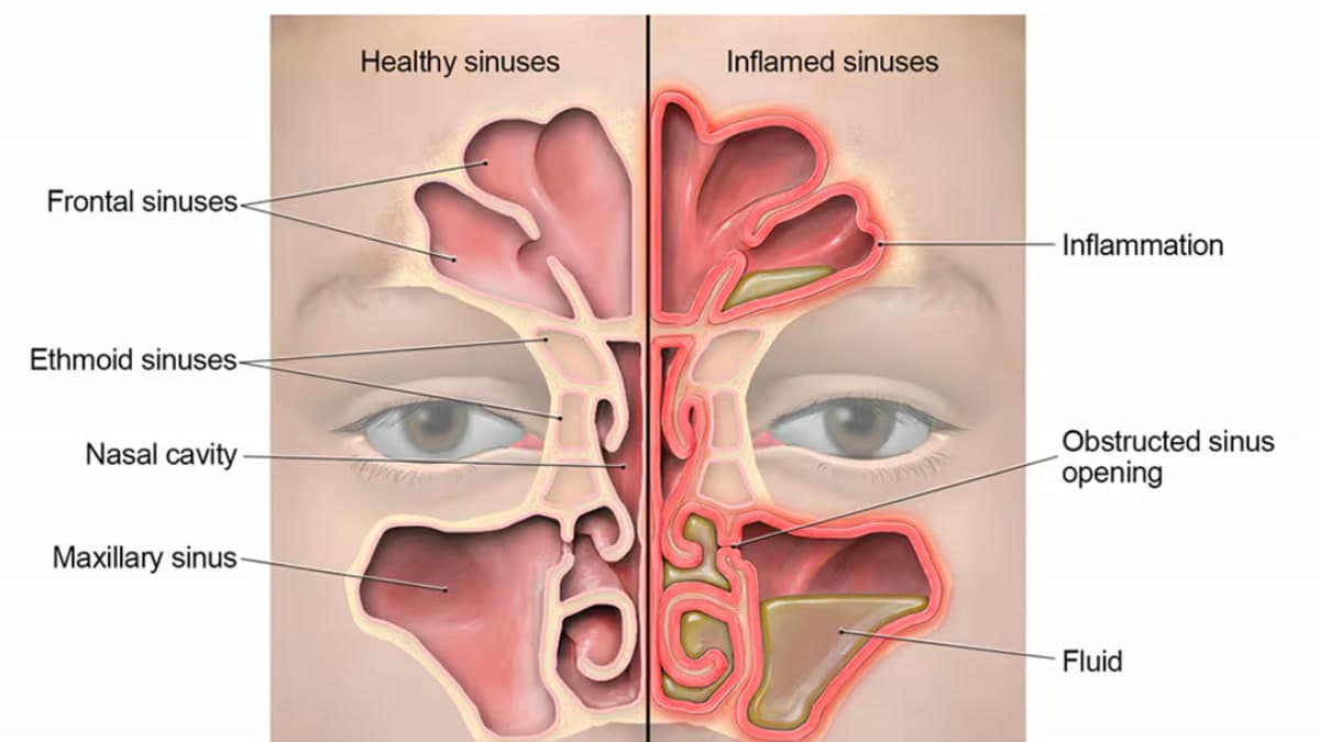 Sağlıklı ve iltihaplı (sinüzitli) sinüsleri karşılaştıran anatomik şema