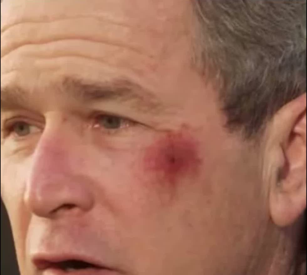 George W. Bush'un yanağındaki morluğun yakın çekimi, video karesi